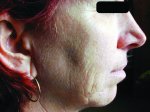 Irregularity Facial Treatments
